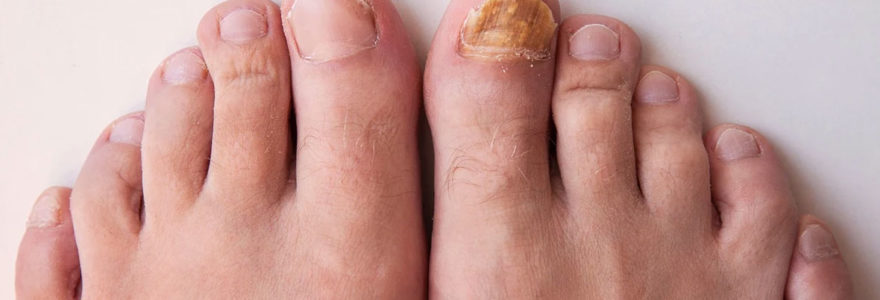 mycose du pied d'athlète